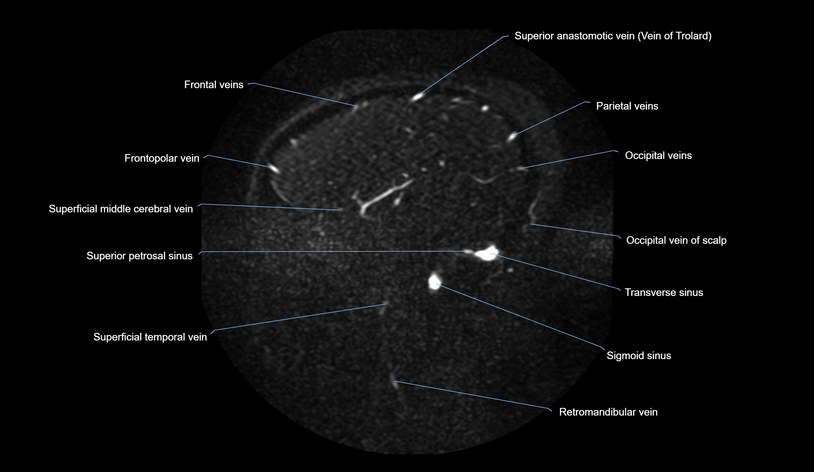 MRV brain sagittal anatomy 3T MRI labelledimages -00065.webp